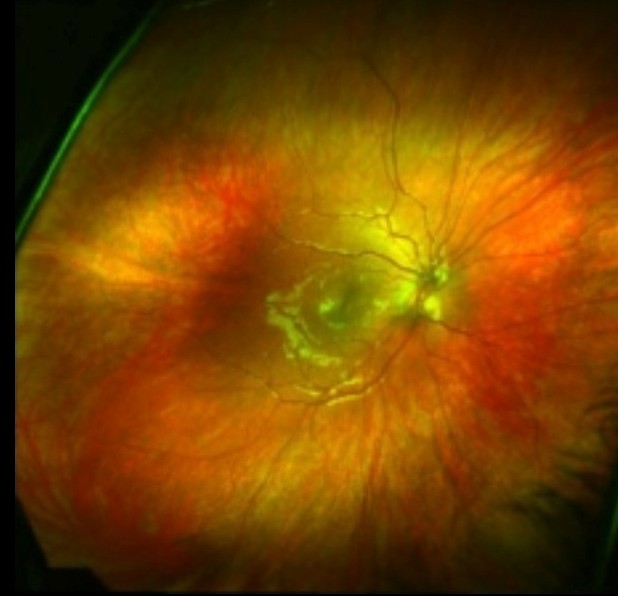 Eye Health